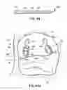 Fig. 65 - Systems and methods for treating the heart with ablation