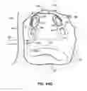 Fig. 68 - Systems and methods for treating the heart with ablation