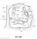 Fig. 70 - Systems and methods for treating the heart with ablation