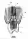 Fig. 03 - Restoration dental implant and method
