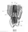Fig. 04 - Restoration dental implant and method