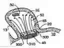 Fig. 01 - Filter apparatus for ostium of left atrial appendage