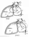 Fig. 02 - Filter apparatus for ostium of left atrial appendage