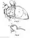 Fig. 03 - Filter apparatus for ostium of left atrial appendage