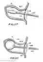 Fig. 09 - Filter apparatus for ostium of left atrial appendage