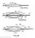Fig. 15 - Filter apparatus for ostium of left atrial appendage