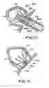 Fig. 23 - Filter apparatus for ostium of left atrial appendage