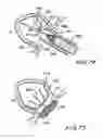 Fig. 25 - Filter apparatus for ostium of left atrial appendage