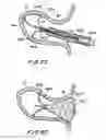 Fig. 27 - Filter apparatus for ostium of left atrial appendage
