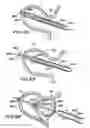 Fig. 29 - Filter apparatus for ostium of left atrial appendage