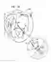 Fig. 14 - Techniques for guide-wire based advancement of artificial chordae