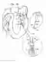 Fig. 15 - Techniques for guide-wire based advancement of artificial chordae