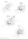 Fig. 19 - Hip joint device and method