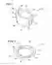 Fig. 02 - Methods for augmenting a tibial component of a knee joint prosthesis