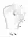 Fig. 18 - Stemless humeral component of an orthopaedic shoulder prosthesis