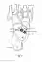 Fig. 08 - Spherical subtalar implant
