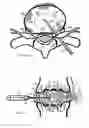 Fig. 07 - Method for relieving pain and regenerating intervertebral disc