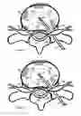 Fig. 08 - Method for relieving pain and regenerating intervertebral disc