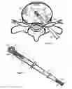 Fig. 11 - Method for relieving pain and regenerating intervertebral disc