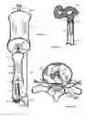 Fig. 12 - Method for relieving pain and regenerating intervertebral disc