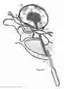 Fig. 16 - Method for relieving pain and regenerating intervertebral disc