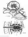 Fig. 17 - Method for relieving pain and regenerating intervertebral disc