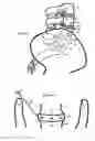 Fig. 19 - Method for relieving pain and regenerating intervertebral disc