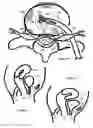 Fig. 20 - Method for relieving pain and regenerating intervertebral disc