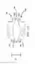 Fig. 11 - Anterior prosthetic spinal disc replacement