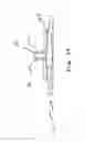 Fig. 22 - Anterior prosthetic spinal disc replacement