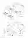 Fig. 07 - Artificial spinal disk prosthesis