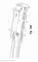 Fig. 20 - Expandable interbody fusion device