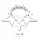 Fig. 03 - In-situ formed intervertebral fusion device and method