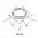 Fig. 04 - In-situ formed intervertebral fusion device and method