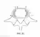 Fig. 05 - In-situ formed intervertebral fusion device and method