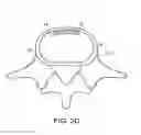 Fig. 06 - In-situ formed intervertebral fusion device and method