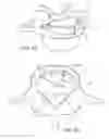 Fig. 08 - In-situ formed intervertebral fusion device and method