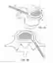 Fig. 11 - In-situ formed intervertebral fusion device and method