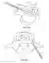Fig. 12 - In-situ formed intervertebral fusion device and method