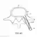 Fig. 16 - In-situ formed intervertebral fusion device and method