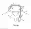 Fig. 17 - In-situ formed intervertebral fusion device and method