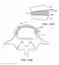 Fig. 18 - In-situ formed intervertebral fusion device and method