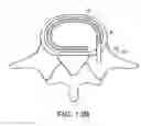 Fig. 22 - In-situ formed intervertebral fusion device and method