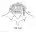 Fig. 23 - In-situ formed intervertebral fusion device and method