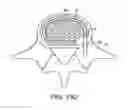 Fig. 24 - In-situ formed intervertebral fusion device and method
