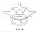 Fig. 27 - In-situ formed intervertebral fusion device and method