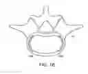 Fig. 28 - In-situ formed intervertebral fusion device and method