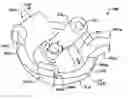 Fig. 01 - DEVICES AND METHODS FOR HIP REPLACEMENT