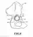 Fig. 09 - DEVICES AND METHODS FOR HIP REPLACEMENT