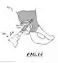 Fig. 13 - DEVICES AND METHODS FOR HIP REPLACEMENT